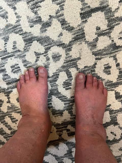 Show some ankle — swollen feet on patterned rug